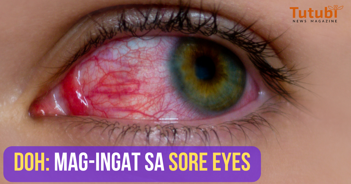 doh-mag-ingat-sa-sore-eyes-tutubi-news-magazine